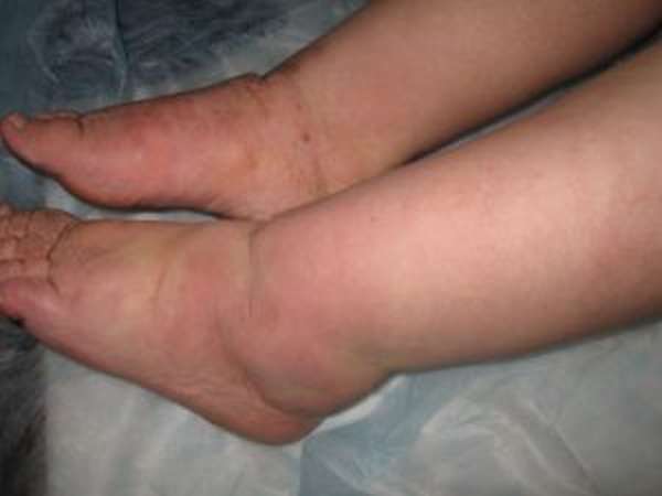 Обертывания для ног от варикоза