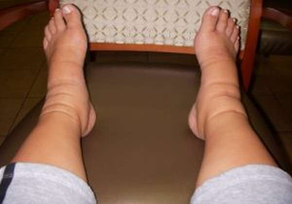 Флебэктомия вен на ногах