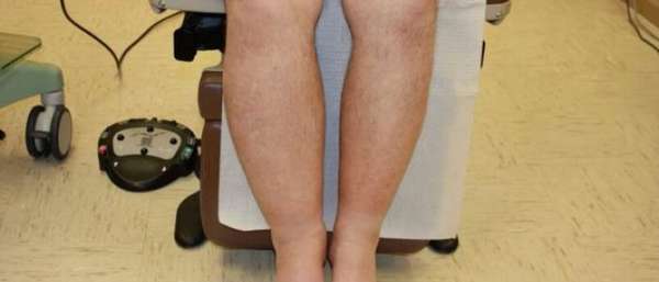 Лимфостаз нижних конечностей симптомы фото и лечение