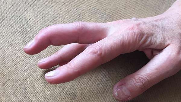 Перелом сухожилия на пальце правой руки