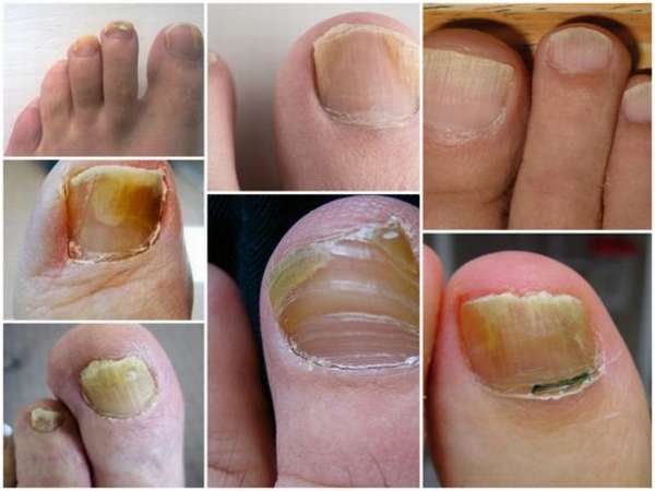 Как вылечить грибок ногтя ноги в начальной стадии
