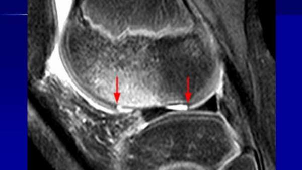 Остеоартрозом суставов позвоночника и периферических суставов thumbnail