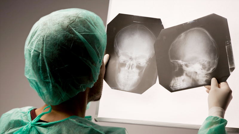 Перелом основания черепа лобной кости