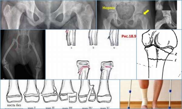 Эпифизеолиз плечевой кости код мкб thumbnail