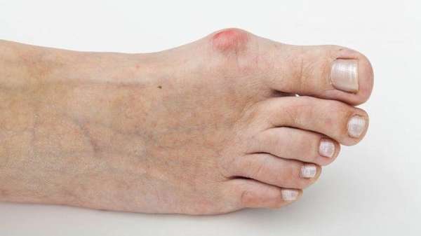 Артрит на большом пальце ноги лечение в домашних