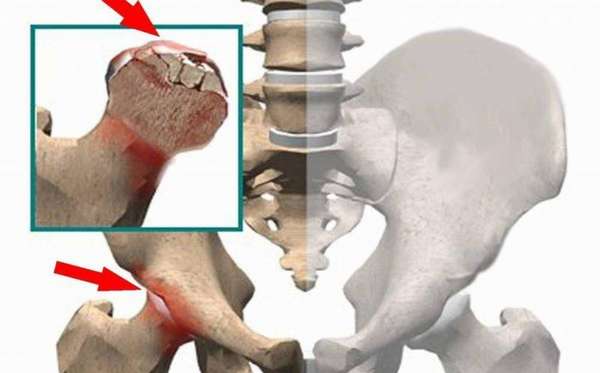 Остеонекроз коленного сустава лечение народными средствами