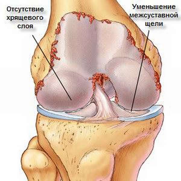 Заболевание деформирующий остеоартроз коленных суставов