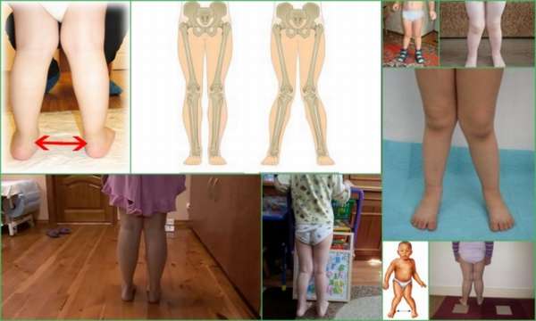 Ребенку 2 года ножки иксом как исправить