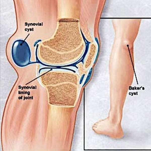 Синовиальная киста коленного сустава