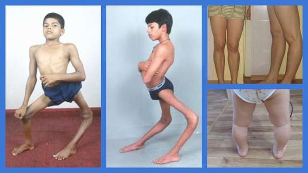 Рекурвация коленного сустава лечение у взрослых