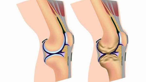 Дегенеративные изменения гиалинового хряща коленного сустава