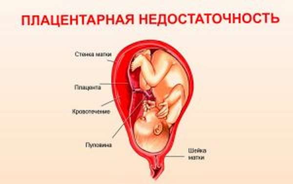 Варикоз матки и беременность