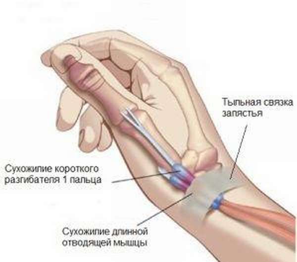 Воспаление сухожилия на руке синдром