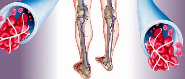 Окклюзивный тромбоз глубоких вен на ногах