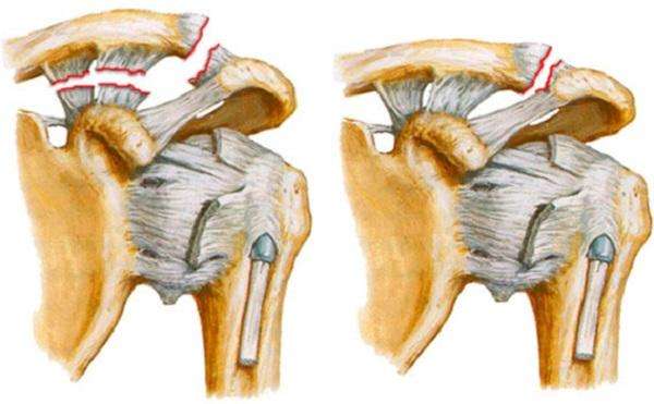 Разрыв акс плечевого сустава без операции