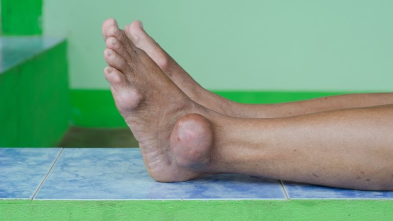 Как обезболить подагру на ноге