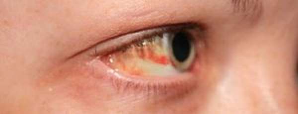 Тромбоз центральной вены сетчатки глаза
