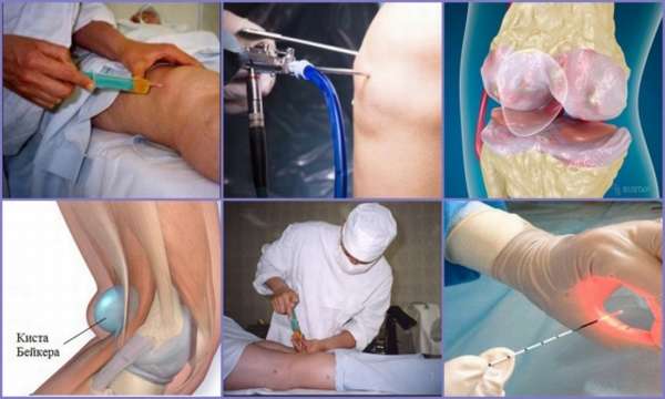 Как проходит операция по удалению кисты коленного сустава