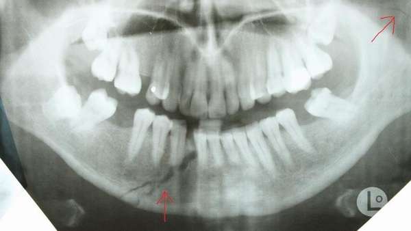 Перелом всей челюсти операция на человека