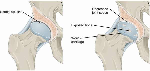 Суставная щель коленного сустава умеренно сужена