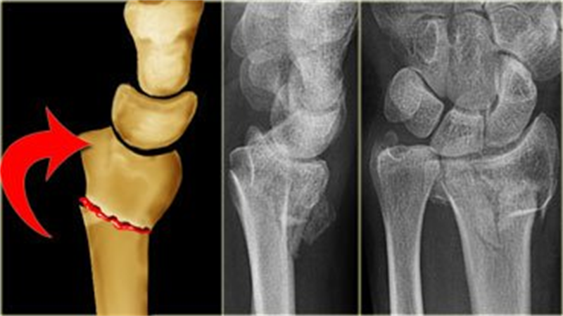 Лечение перелома лучевой кости локтевого сустава