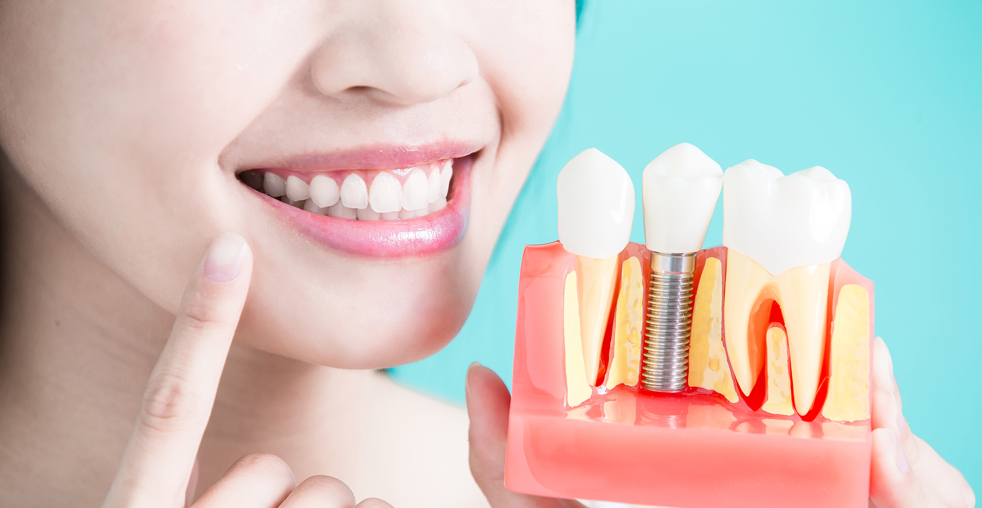 Все что нужно знать об имплантации зубов