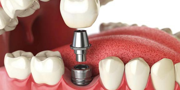 Имплантация зубов: Восстановление Улыбки и Здоровья Стоматологической Имплантацией