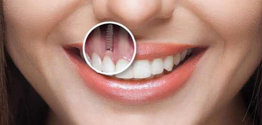 Имплантация зубов: Восстановление Улыбки и Здоровья Стоматологической Имплантацией